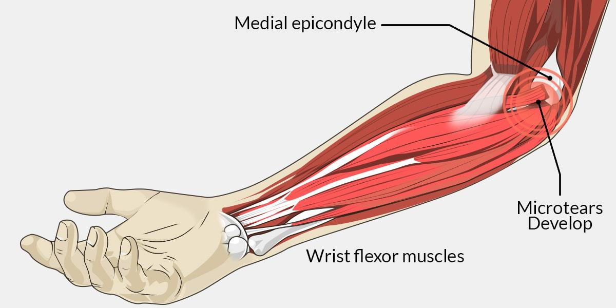 Golfers Elbow