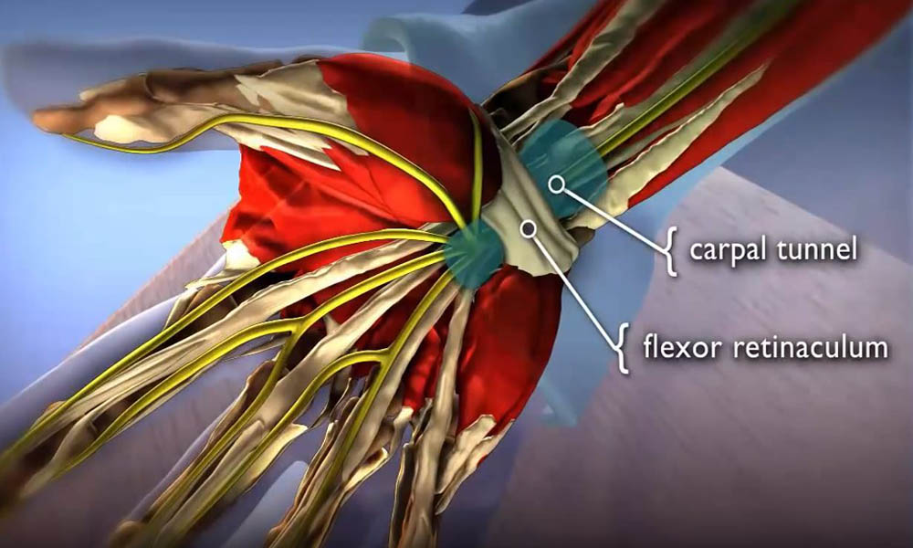 Carpel Tunnel Syndrome